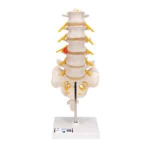 3B Lumbar Spinal Column w/Prolapsed Disc