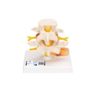 3B Lumbar Vertebrae w/Prolapsed Disc