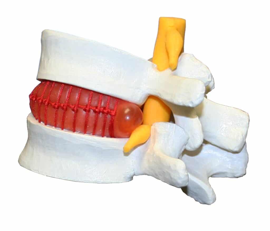Walter Prolapsed Intervertebral Disc - Isaac Technologies Corp