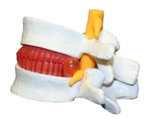 Walter Prolapsed Intervertebral Disc